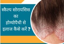 Scalp Psoriasis Treatment In Hindi